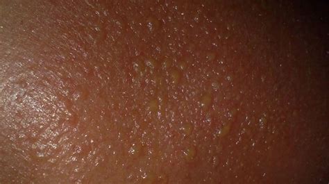 Sun Blister: Symptoms, Causes, Diagnosis, and。